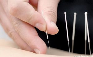 صادرات سوزن های فیزیوتراپی